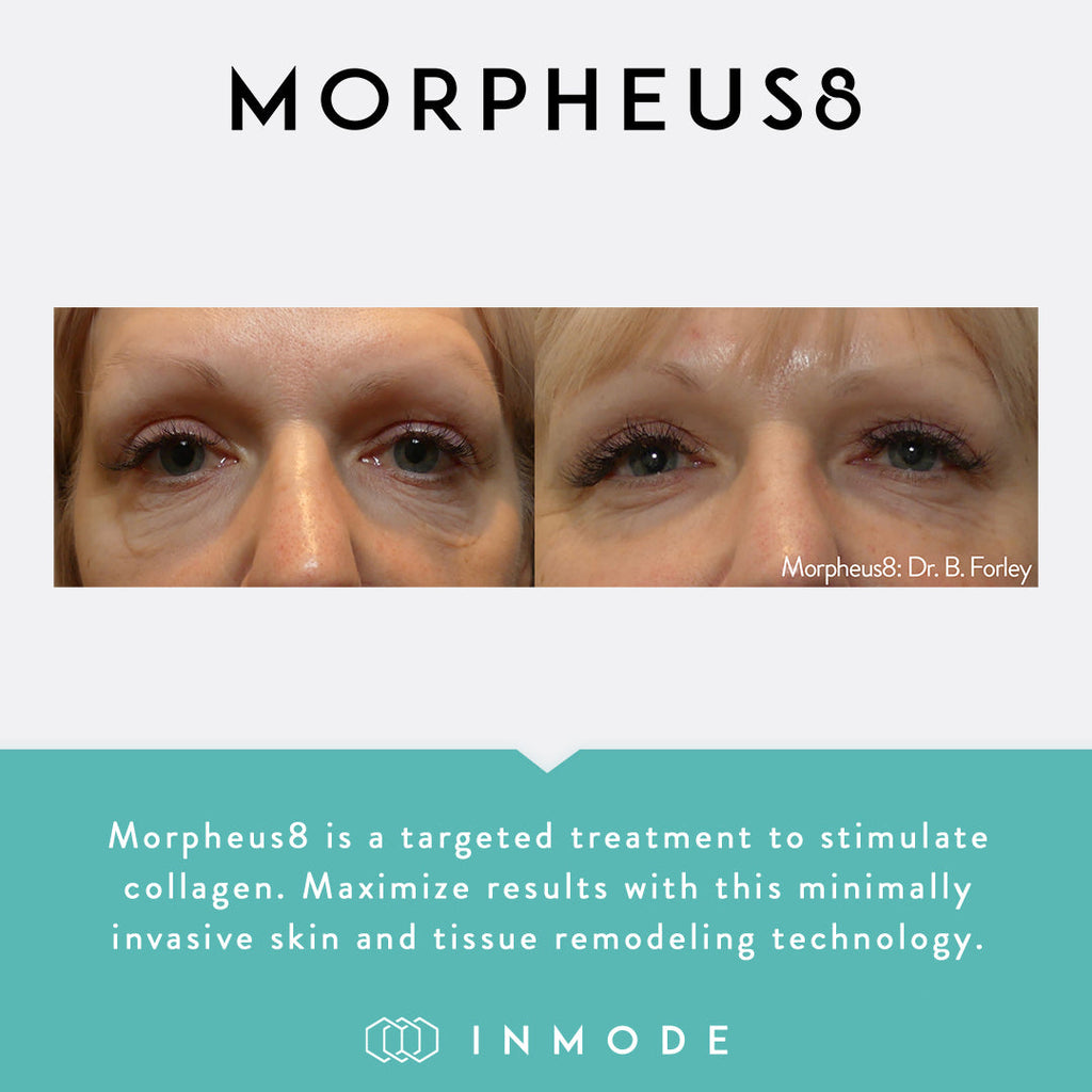 Morpheus8 Radiofrequency